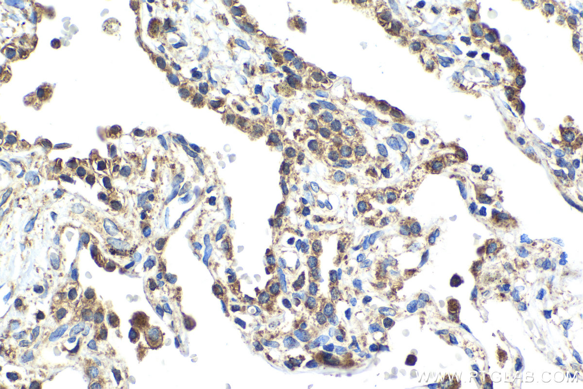 Immunohistochemical analysis of paraffin-embedded human lung tissue slide using KHC2043 (QSOX1/Quiescin Q6 IHC Kit).