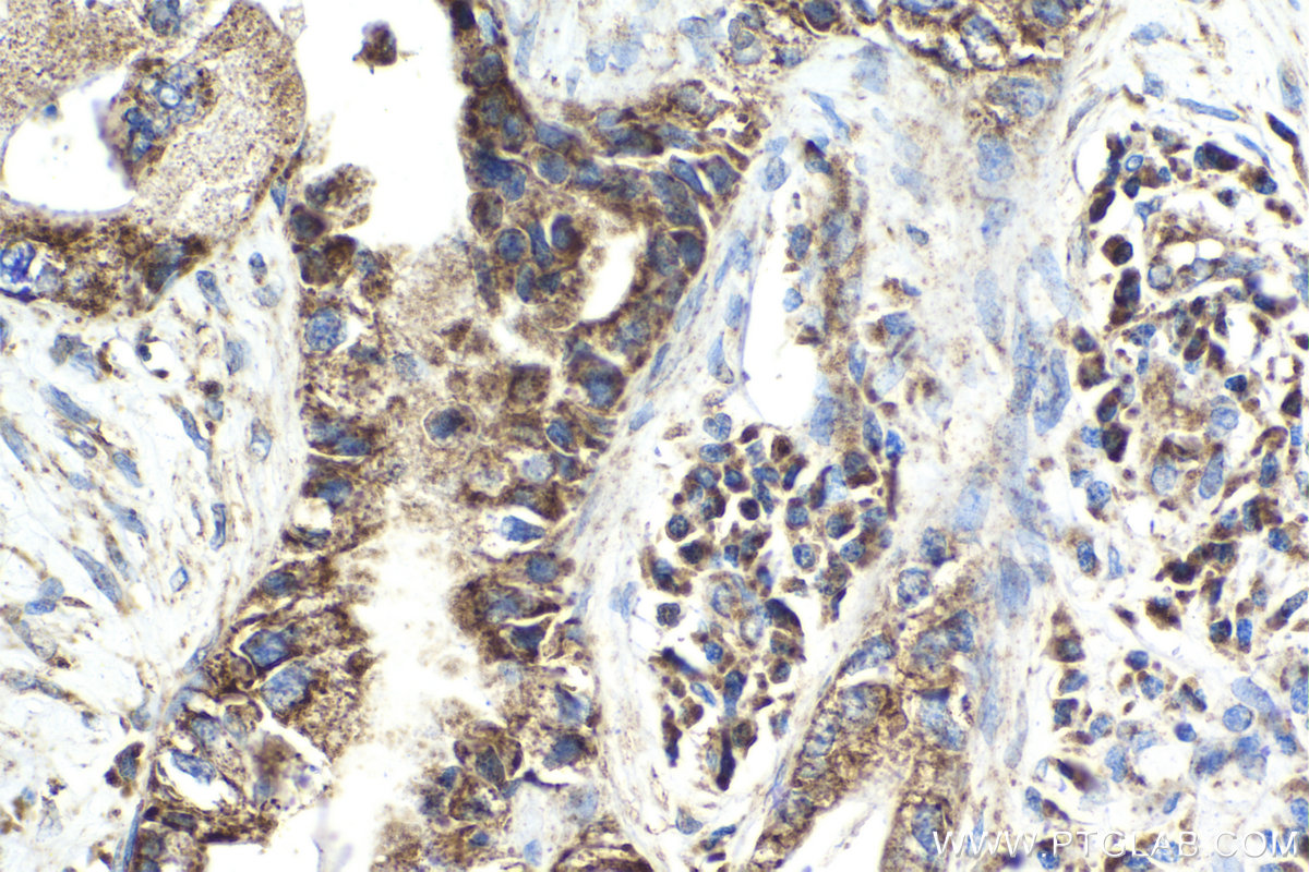 Immunohistochemical analysis of paraffin-embedded human pancreas cancer tissue slide using KHC2043 (QSOX1/Quiescin Q6 IHC Kit).