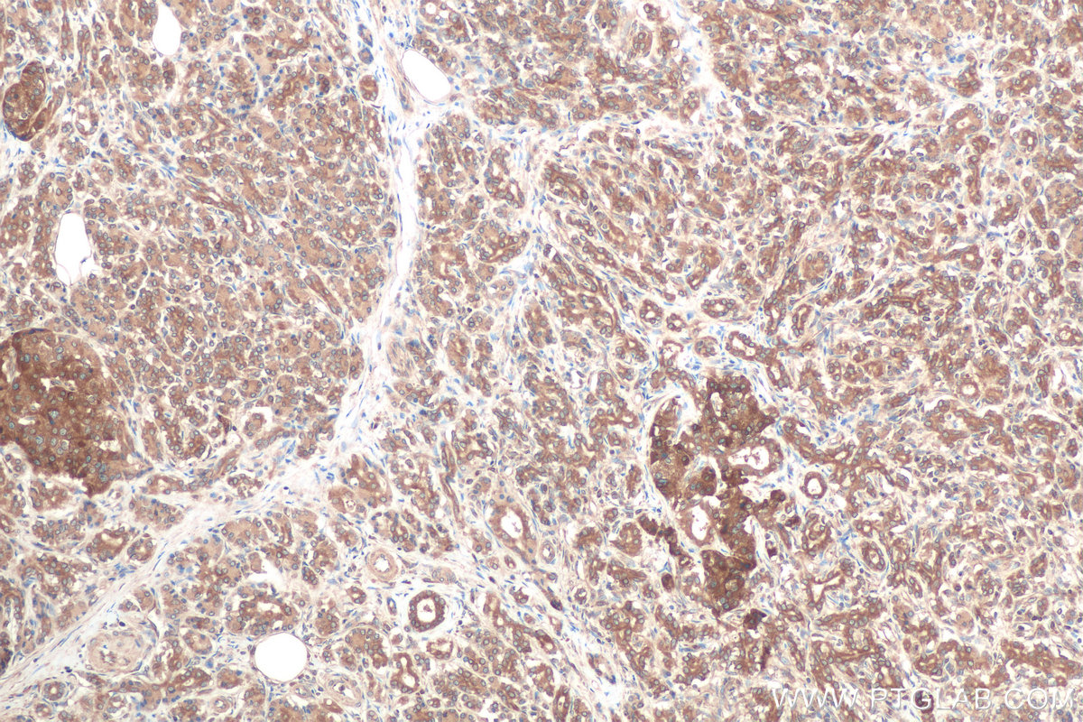 Immunohistochemical analysis of paraffin-embedded human pancreas cancer tissue slide using KHC0838 (RAB1B IHC Kit).