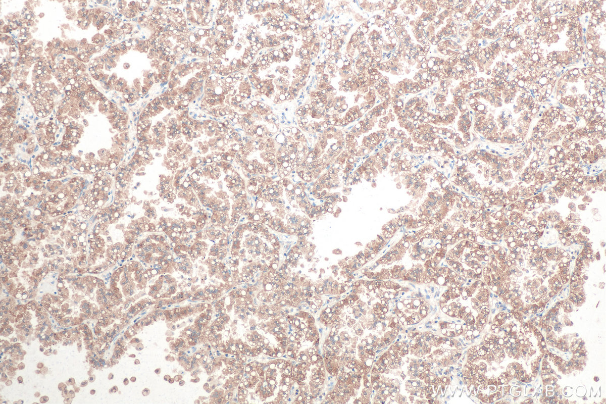 Immunohistochemical analysis of paraffin-embedded human lung cancer tissue slide using KHC0838 (RAB1B IHC Kit).