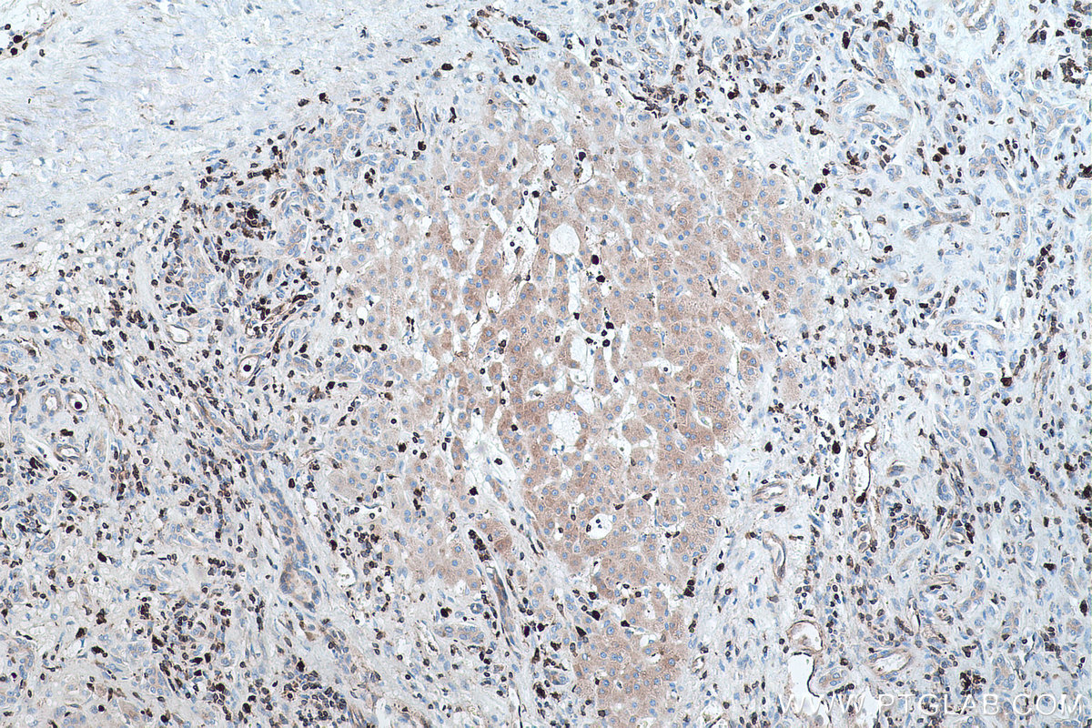 Immunohistochemical analysis of paraffin-embedded human liver cancer tissue slide using KHC0450 (RAB27A IHC Kit).