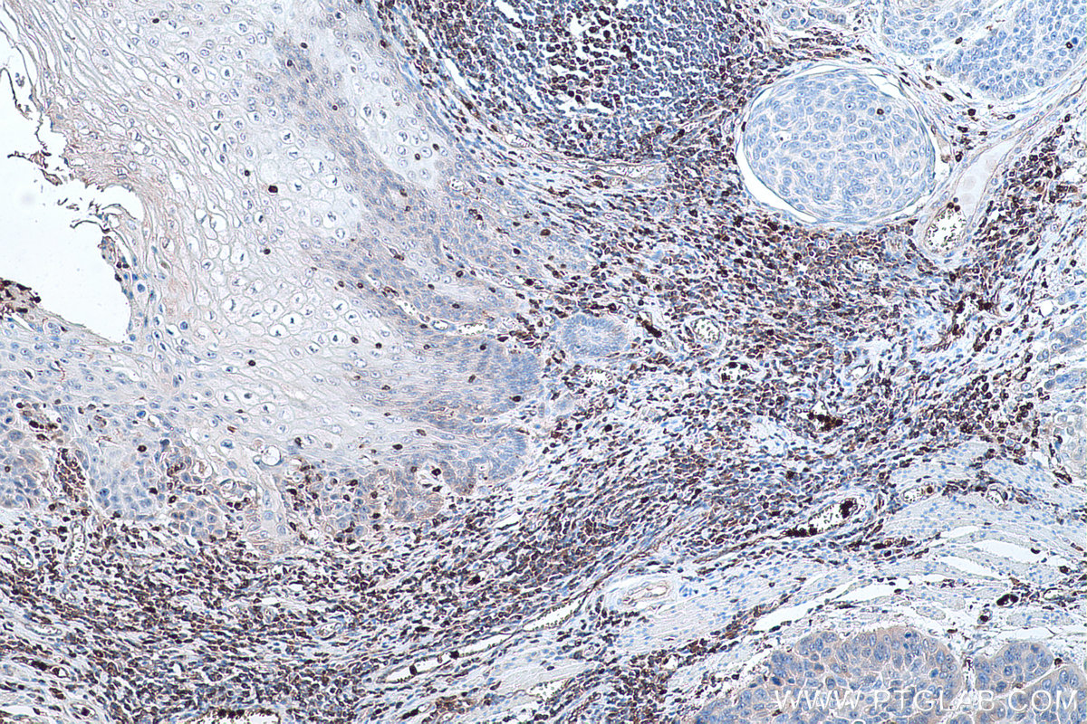 Immunohistochemical analysis of paraffin-embedded human oesophagus cancer tissue slide using KHC0450 (RAB27A IHC Kit).