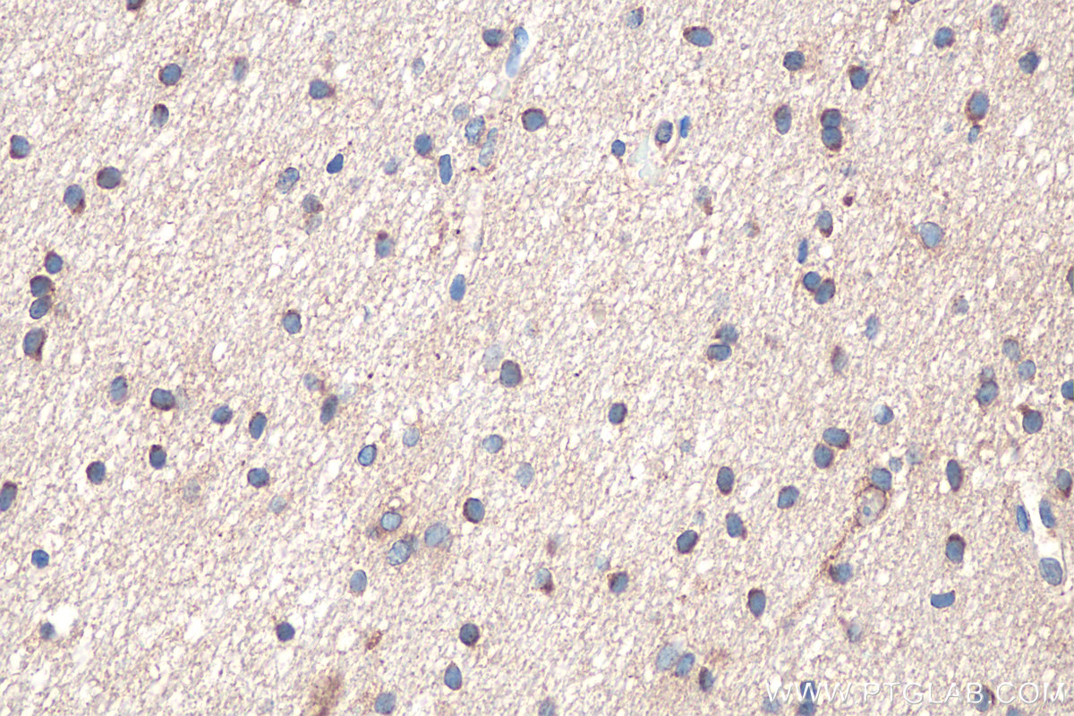 Immunohistochemical analysis of paraffin-embedded human gliomas tissue slide using KHC0912 (RAB2A IHC Kit).