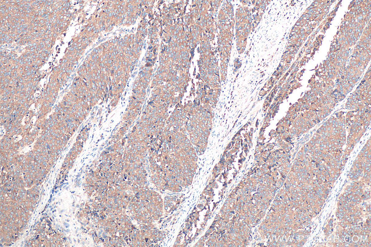 Immunohistochemical analysis of paraffin-embedded human stomach cancer tissue slide using KHC0912 (RAB2A IHC Kit).