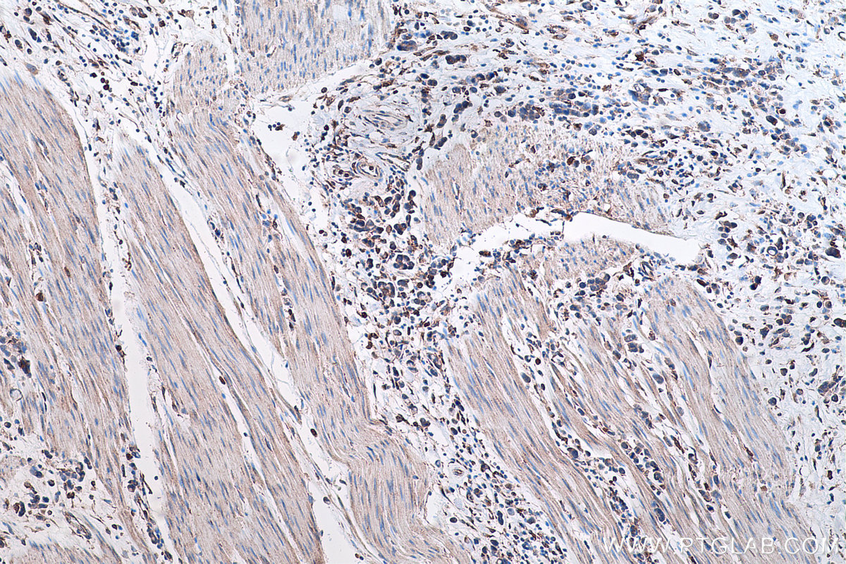 Immunohistochemical analysis of paraffin-embedded human stomach cancer tissue slide using KHC0451 (RAB32 IHC Kit).