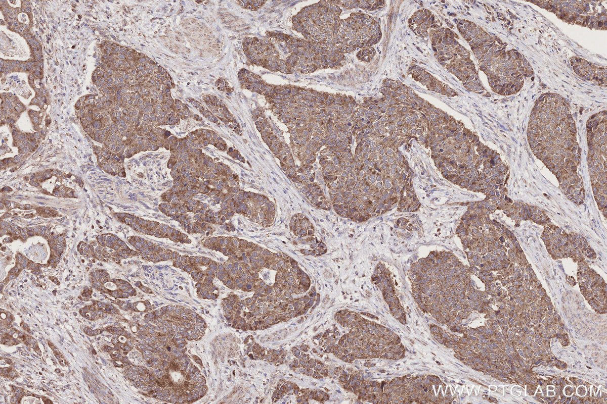 Immunohistochemical analysis of paraffin-embedded human stomach cancer tissue slide using KHC2785 (RAB39B IHC Kit).
