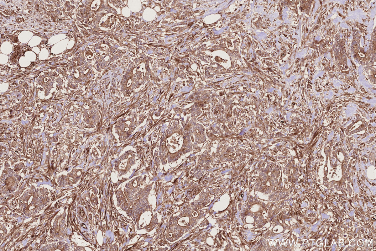 Immunohistochemical analysis of paraffin-embedded human rectal cancer tissue slide using KHC2766 (RAB8 IHC Kit).