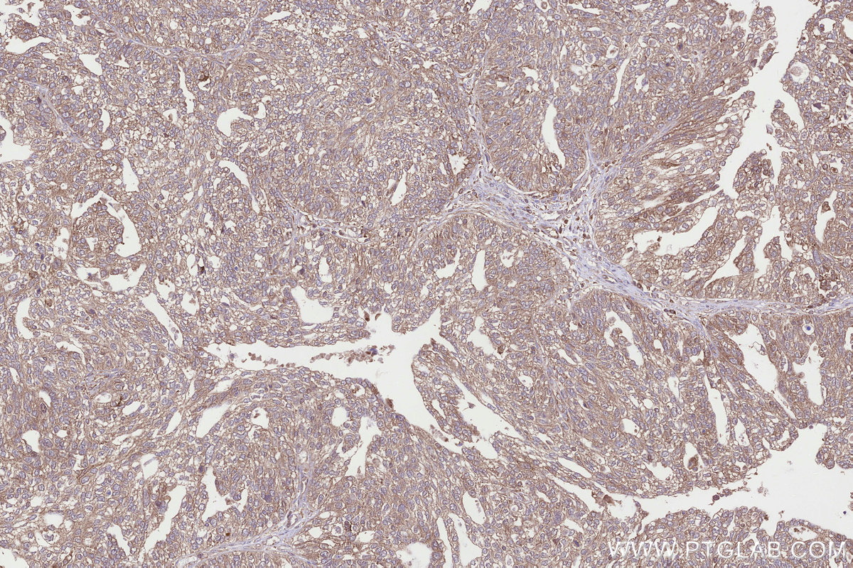 Immunohistochemical analysis of paraffin-embedded human ovary cancer tissue slide using KHC3307 (RABGGTA IHC Kit).