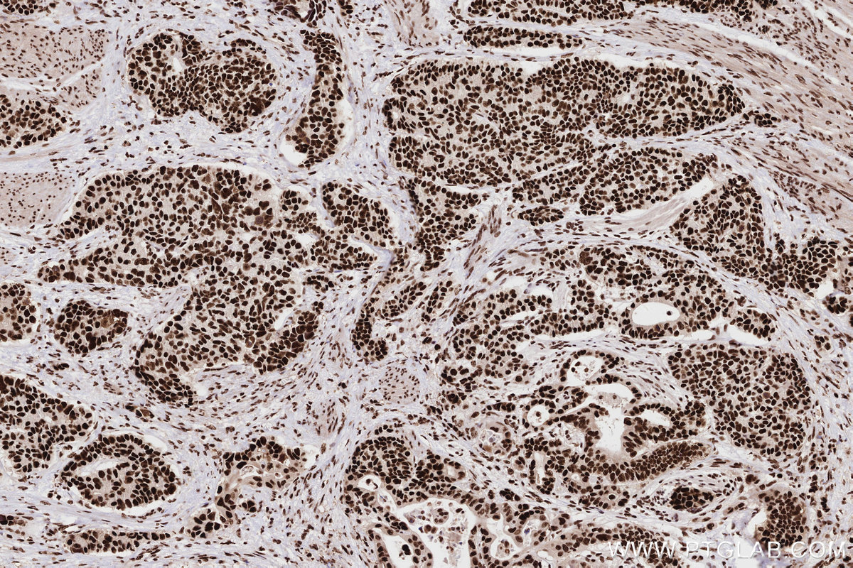 Immunohistochemical analysis of paraffin-embedded human stomach cancer tissue slide using KHC2763 (RAD50 IHC Kit).