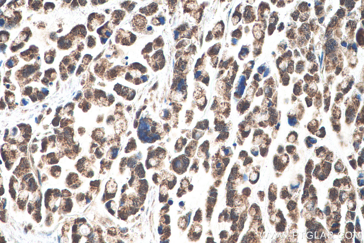 Immunohistochemical analysis of paraffin-embedded human colon cancer tissue slide using KHC0965 (RAE1 IHC Kit).
