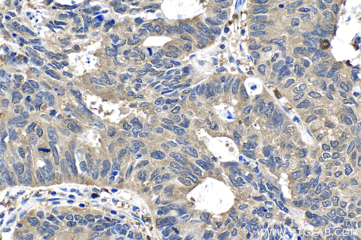 Immunohistochemical analysis of paraffin-embedded human lung cancer tissue slide using KHC1506 (RAF1 IHC Kit).