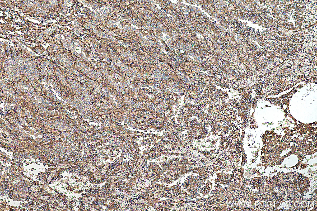 Immunohistochemical analysis of paraffin-embedded human lung cancer tissue slide using KHC0271 (RALB IHC Kit).