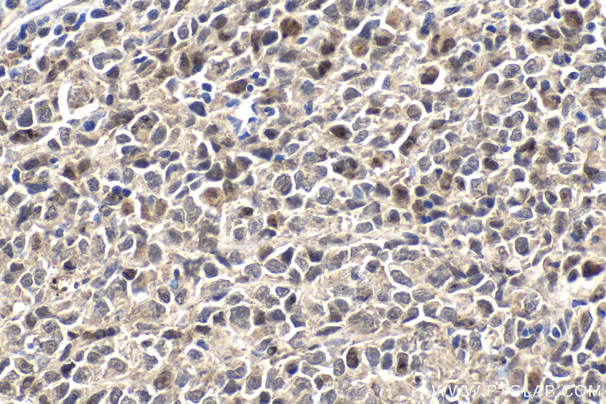 Immunohistochemical analysis of paraffin-embedded human malignant melanoma tissue slide using KHC1793 (RANBP10 IHC Kit).