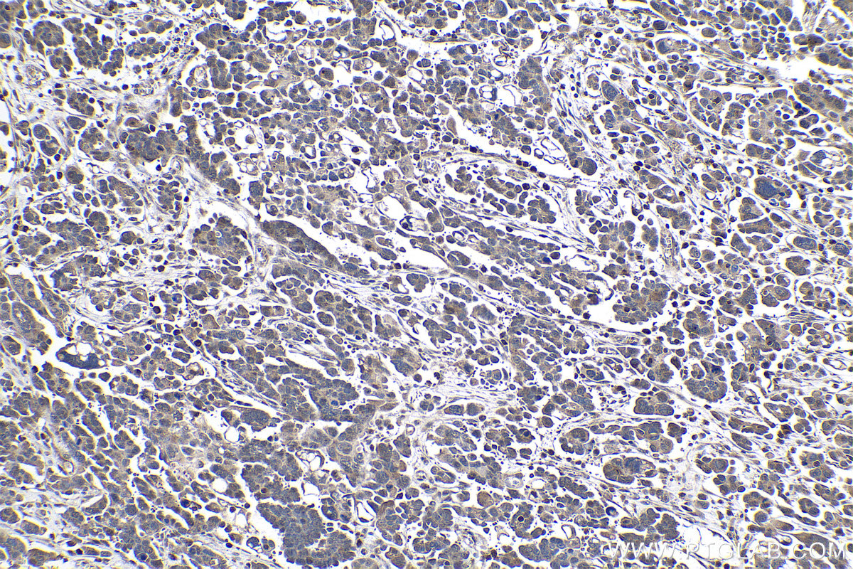 Immunohistochemical analysis of paraffin-embedded human colon cancer tissue slide using KHC1041 (RANBP9 IHC Kit).