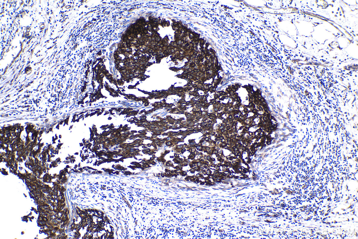 Immunohistochemical analysis of paraffin-embedded human breast cancer tissue slide using KHC1521 (RARA IHC Kit).