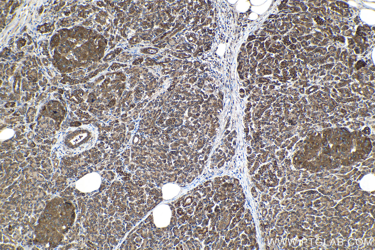 Immunohistochemical analysis of paraffin-embedded human pancreas cancer tissue slide using KHC1522 (RARB IHC Kit).