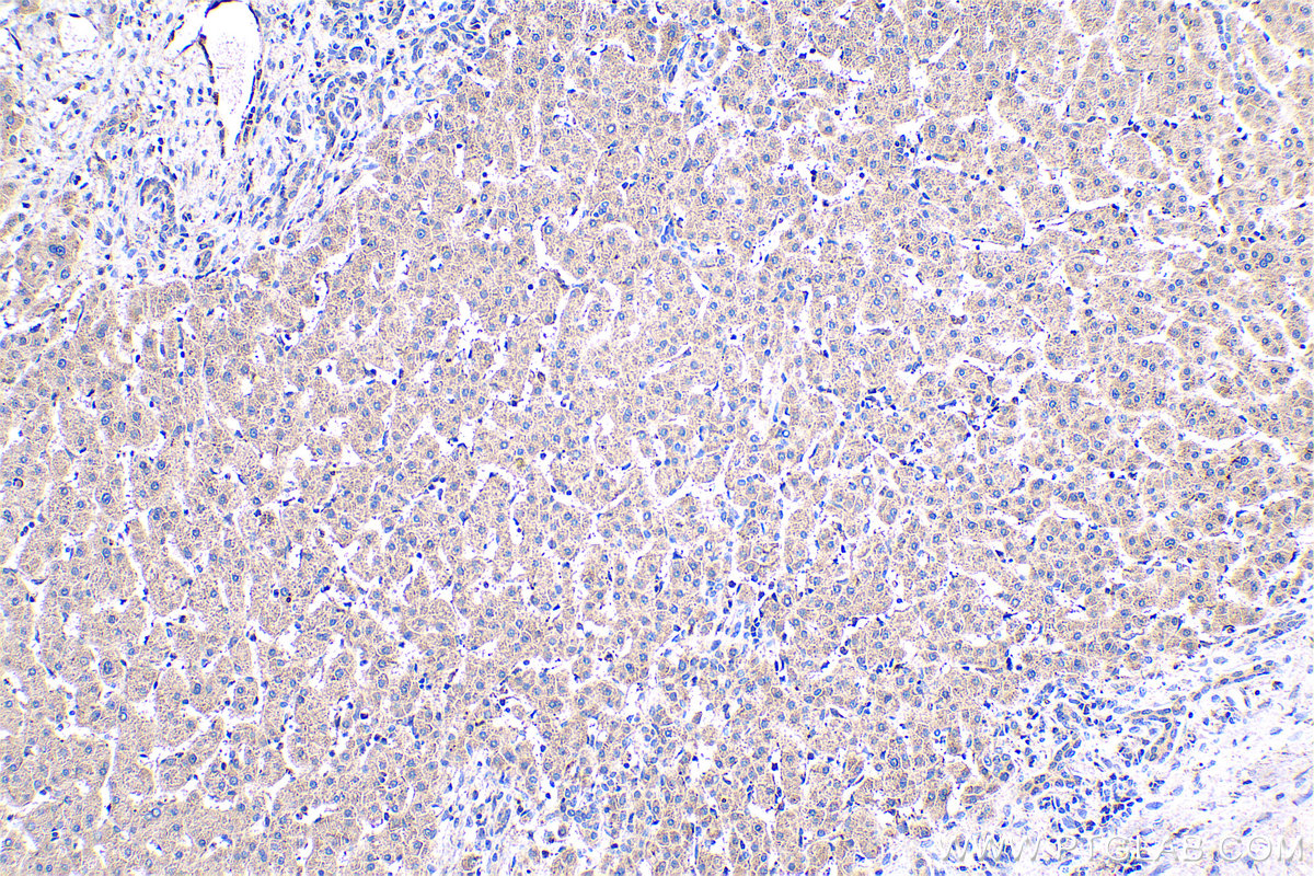 Immunohistochemical analysis of paraffin-embedded human liver cancer tissue slide using KHC0452 (RARRES2 IHC Kit).