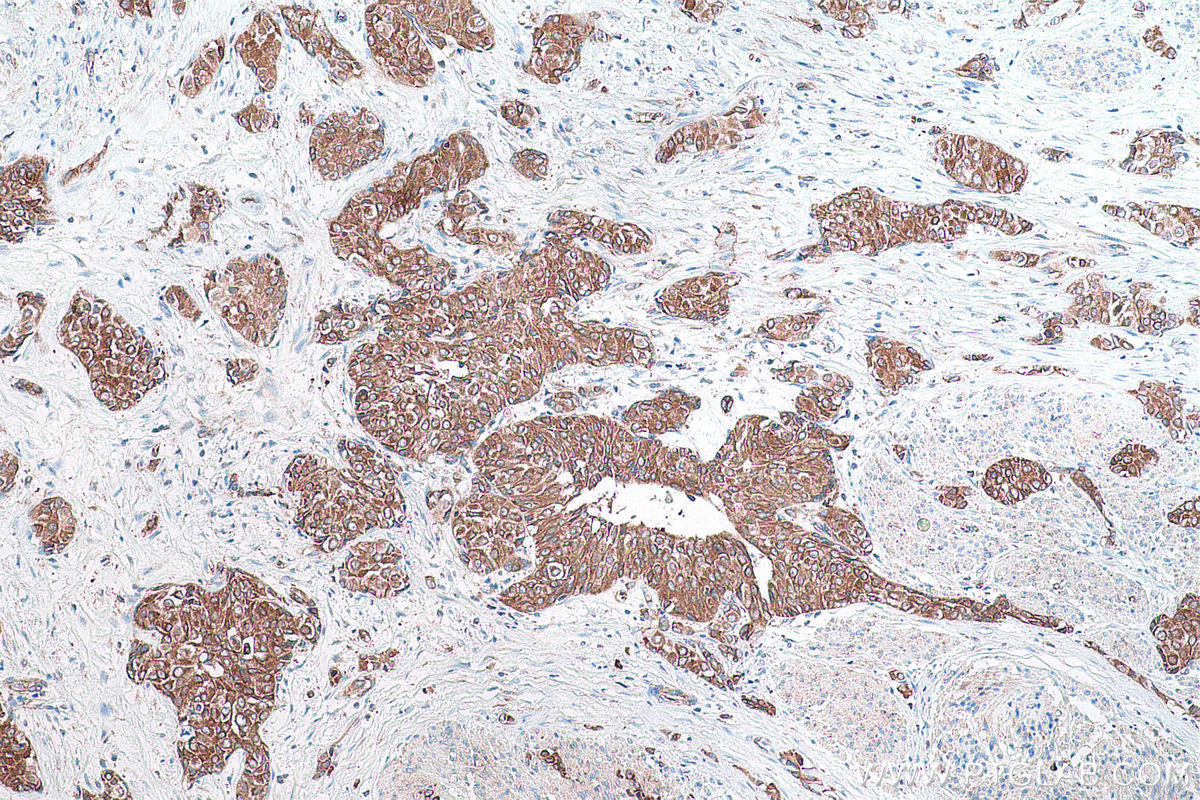 Immunohistochemical analysis of paraffin-embedded human urothelial carcinoma tissue slide using KHC0867 (RARS1 IHC Kit).