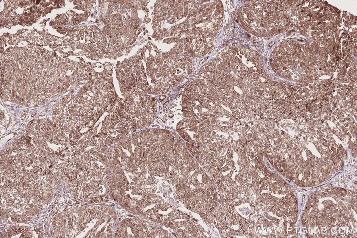 Immunohistochemical analysis of paraffin-embedded human ovary cancer tissue slide using KHC2721 (RB1CC1 IHC Kit).
