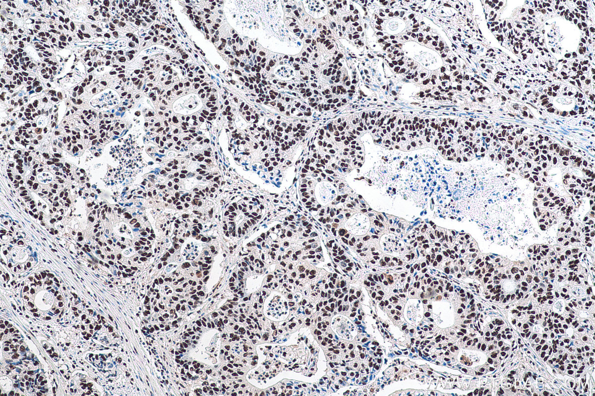 Immunohistochemical analysis of paraffin-embedded human stomach cancer tissue slide using KHC0918 (RBBP4 IHC Kit).