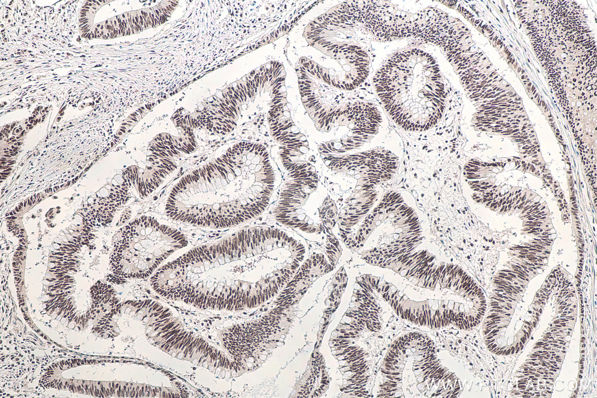 Immunohistochemical analysis of paraffin-embedded human colon cancer tissue slide using KHC0150 (RBM15 IHC Kit).