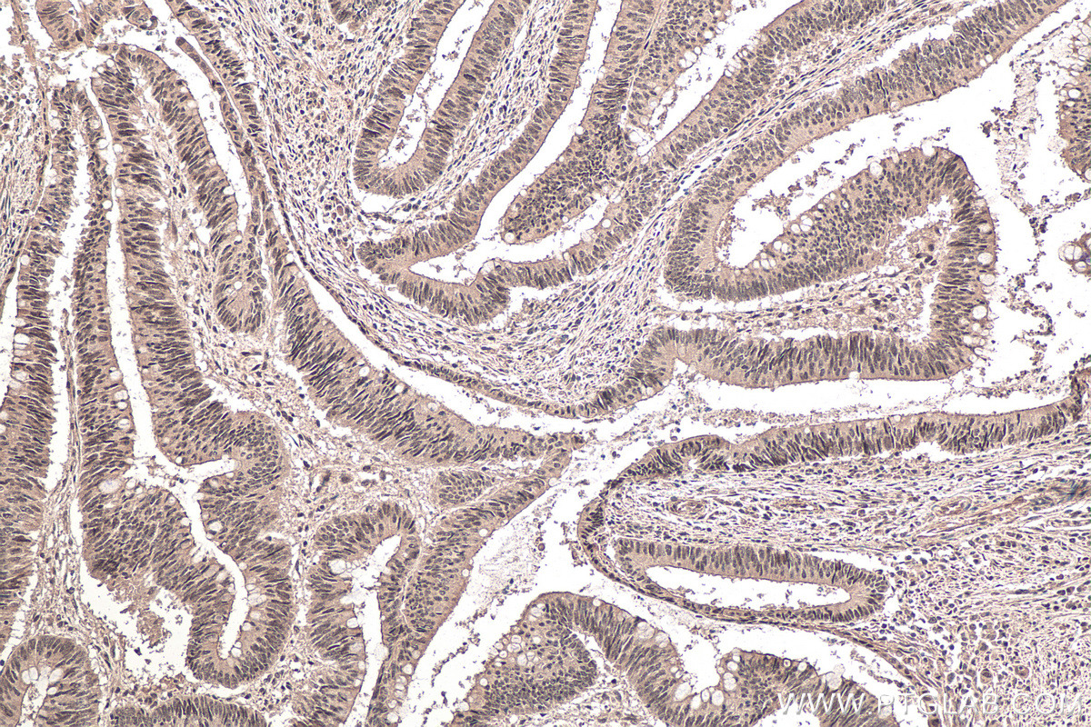 Immunohistochemical analysis of paraffin-embedded human colon cancer tissue slide using KHC0151 (RBM15B IHC Kit).