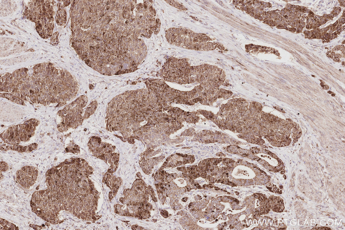 Immunohistochemical analysis of paraffin-embedded human stomach cancer tissue slide using KHC2901 (RBM38 IHC Kit).