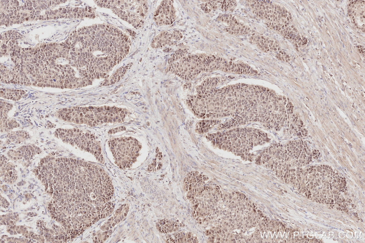 Immunohistochemical analysis of paraffin-embedded human stomach cancer tissue slide using KHC2878 (RBM4 IHC Kit).