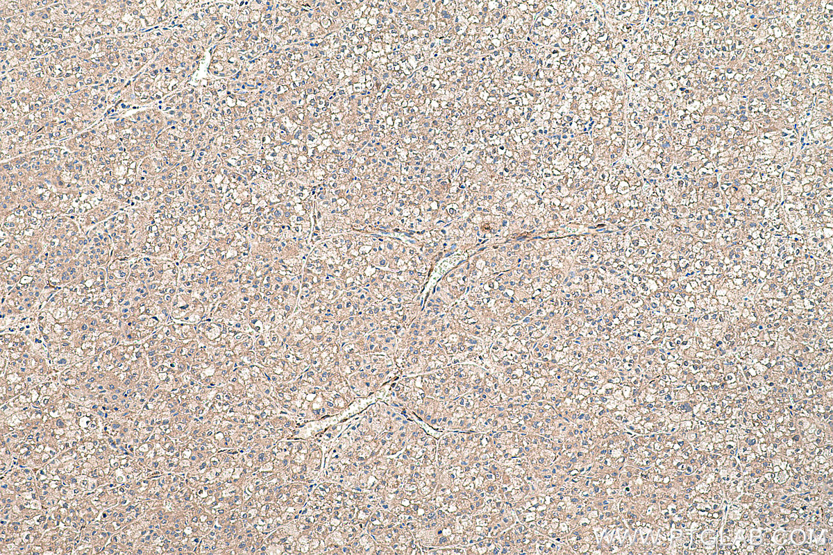 Immunohistochemical analysis of paraffin-embedded human liver cancer tissue slide using KHC0453 (RBP1 IHC Kit).