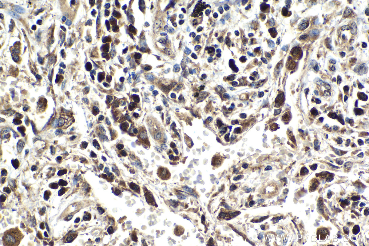 Immunohistochemical analysis of paraffin-embedded human lung tissue slide using KHC2050 (RCAS1 IHC Kit).