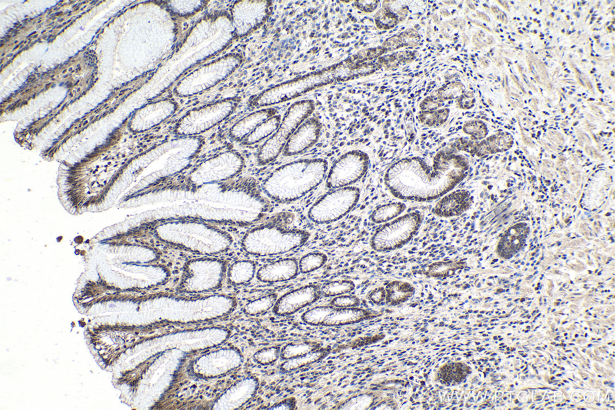 Immunohistochemical analysis of paraffin-embedded human stomach cancer tissue slide using KHC1015 (RCC2 IHC Kit).