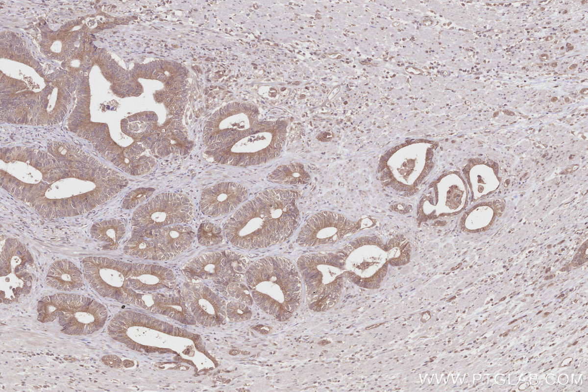 Immunohistochemical analysis of paraffin-embedded human rectal cancer tissue slide using KHC2814 (RCHY1/Pirh2 IHC Kit).
