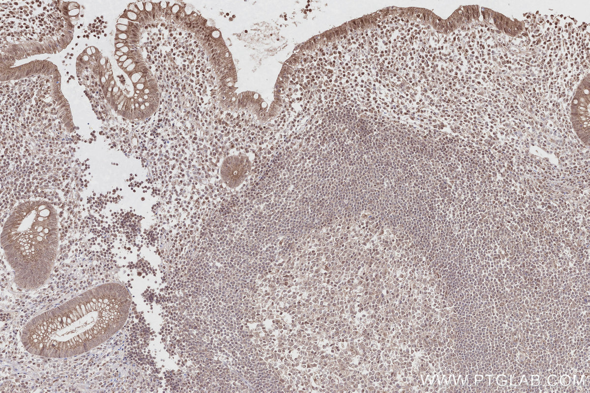 Immunohistochemical analysis of paraffin-embedded human appendicitis tissue slide using KHC2814 (RCHY1/Pirh2 IHC Kit).