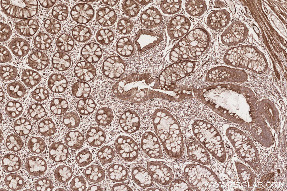 Immunohistochemical analysis of paraffin-embedded human rectal cancer tissue slide using KHC2619 (RD3 IHC Kit).