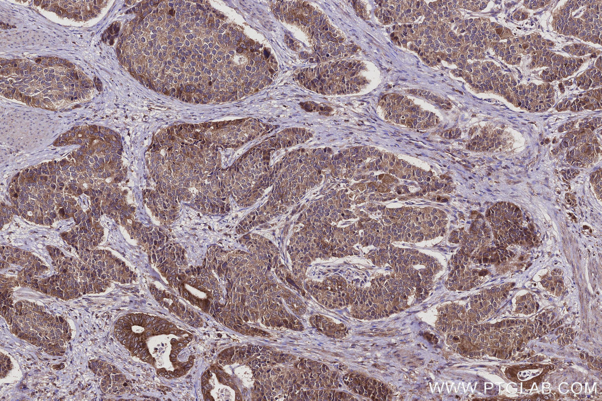 Immunohistochemical analysis of paraffin-embedded human stomach cancer tissue slide using KHC2920 (REEP4 IHC Kit).