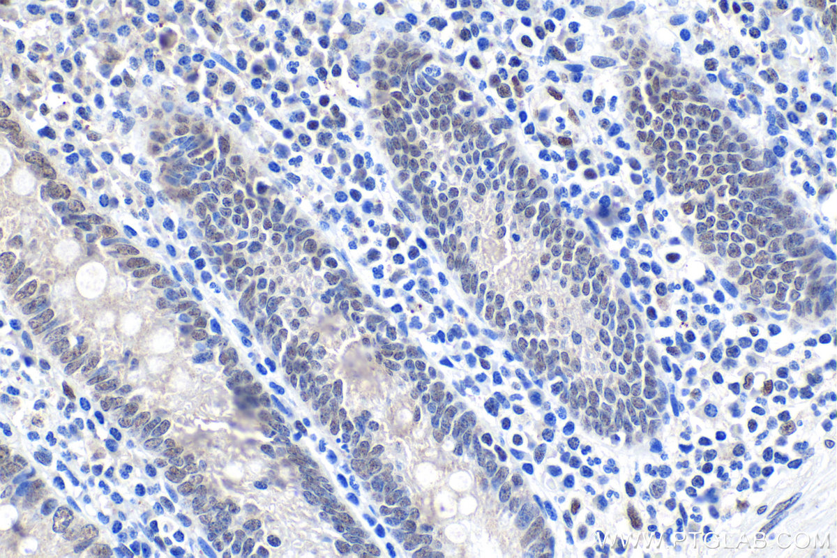 Immunohistochemical analysis of paraffin-embedded human appendicitis tissue slide using KHC1610 (RFX5 IHC Kit).