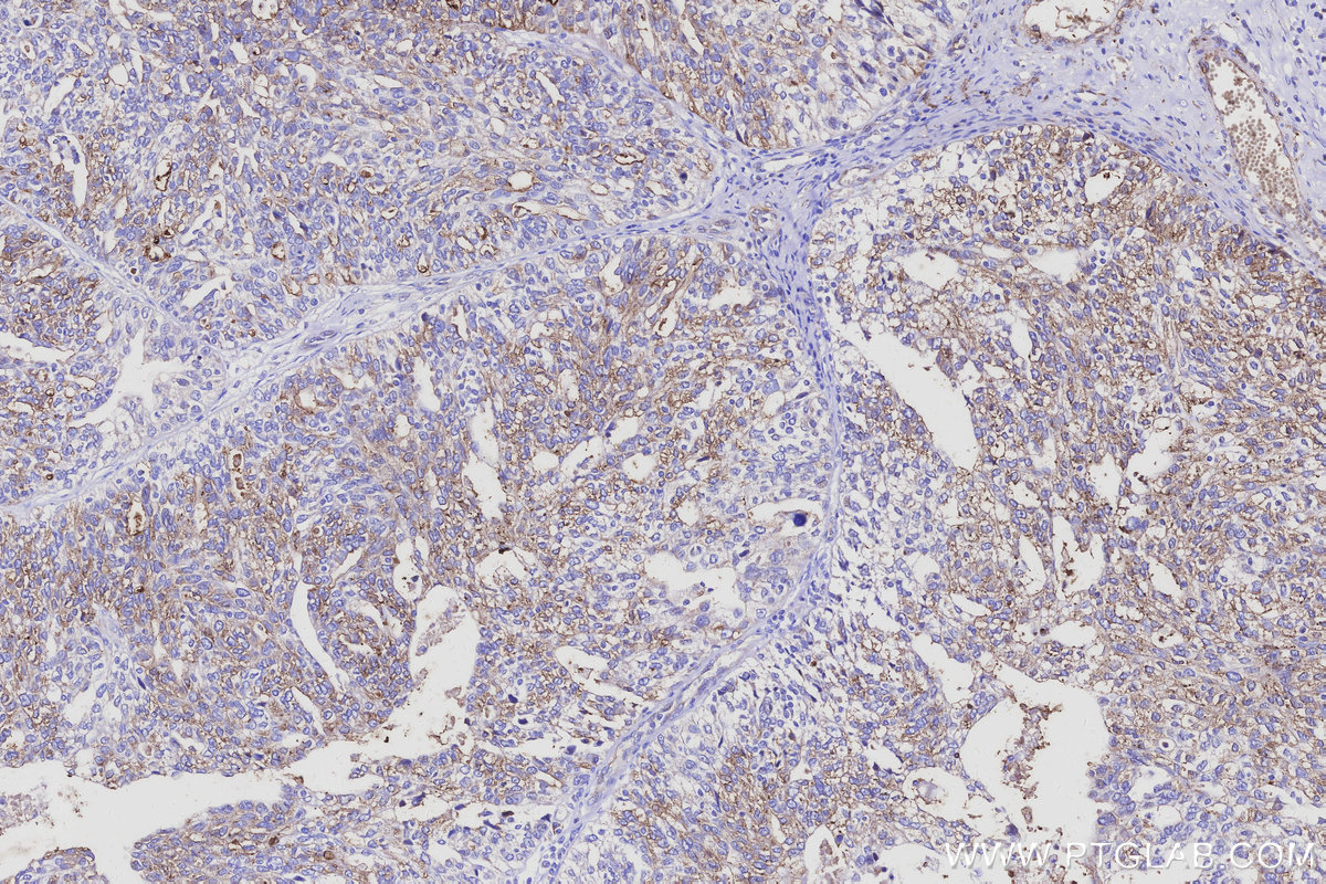 Immunohistochemical analysis of paraffin-embedded human ovary cancer tissue slide using KHC3113 (RGPD5 IHC Kit). Immunohistochemical analysis of paraffin-embedded human ovary cancer tissue slide using KHC3113 (RGPD5 IHC Kit).