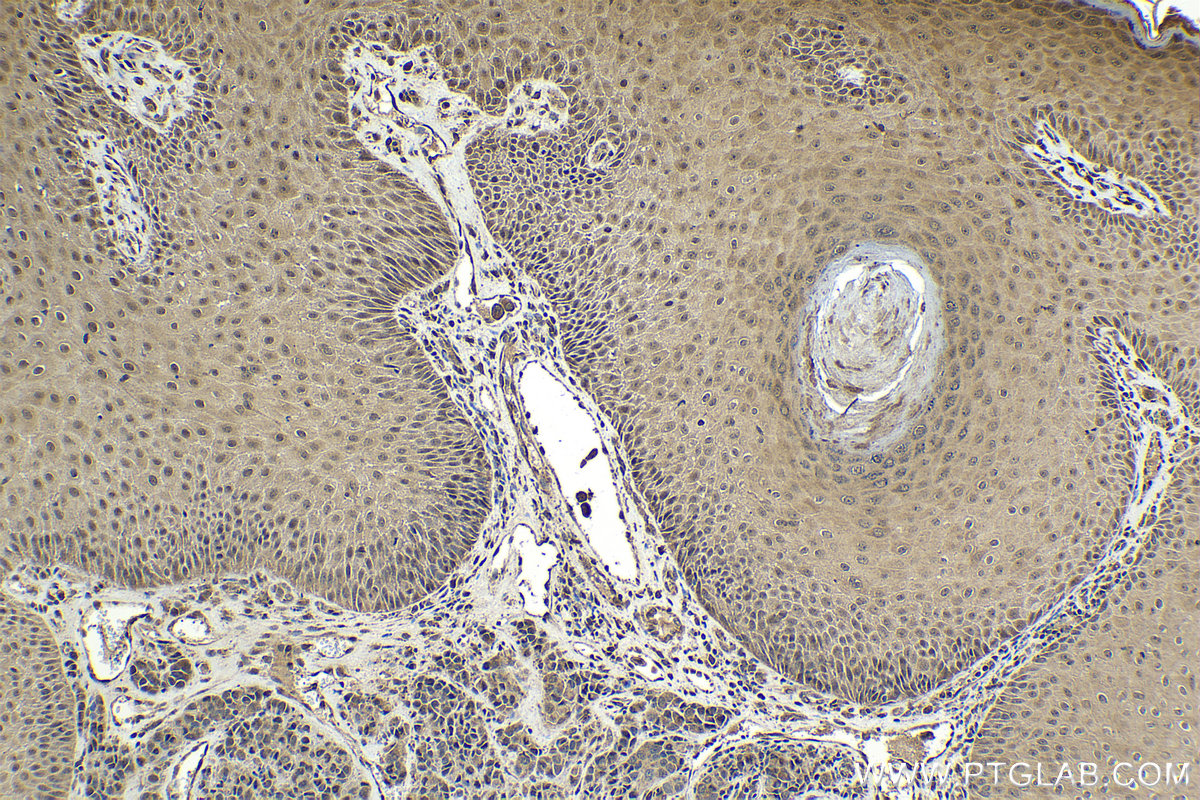 Immunohistochemical analysis of paraffin-embedded human malignant melanoma tissue slide using KHC2061 (RGS12 IHC Kit).