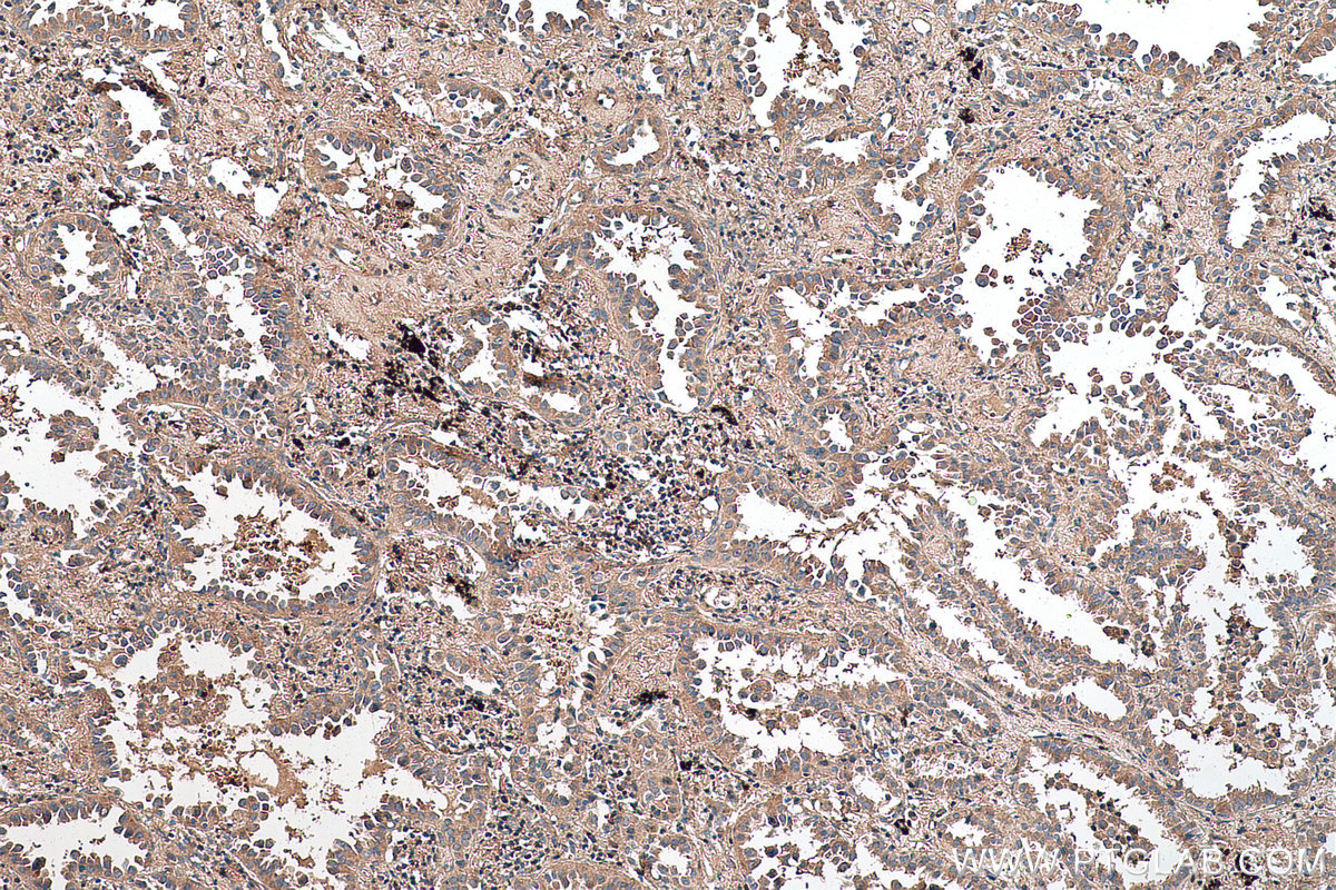 Immunohistochemical analysis of paraffin-embedded human lung cancer tissue slide using KHC0638 (RHOA IHC Kit).