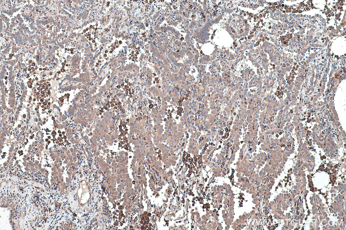 Immunohistochemical analysis of paraffin-embedded human lung cancer tissue slide using KHC0454 (RHOB IHC Kit).