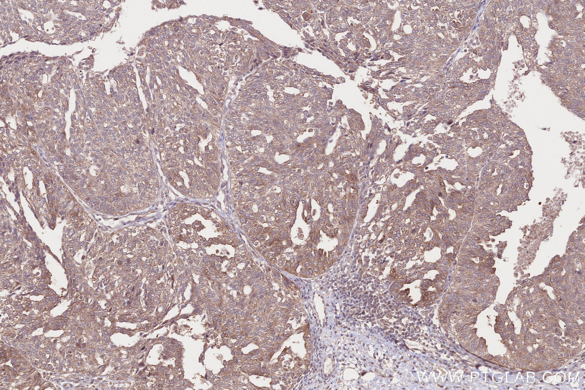 Immunohistochemical analysis of paraffin-embedded human ovary cancer tissue slide using KHC2642 (RHPN2 IHC Kit).