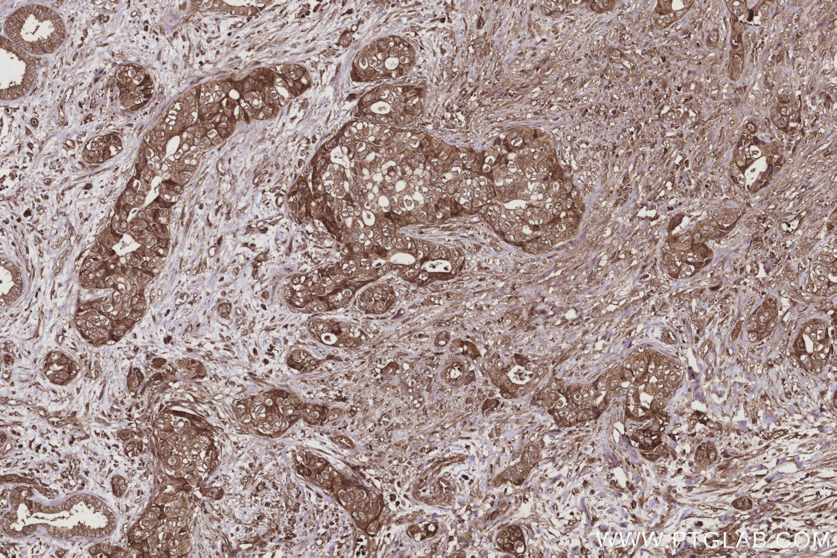 Immunohistochemical analysis of paraffin-embedded human pancreas cancer tissue slide using KHC2937 (RIC8A IHC Kit).