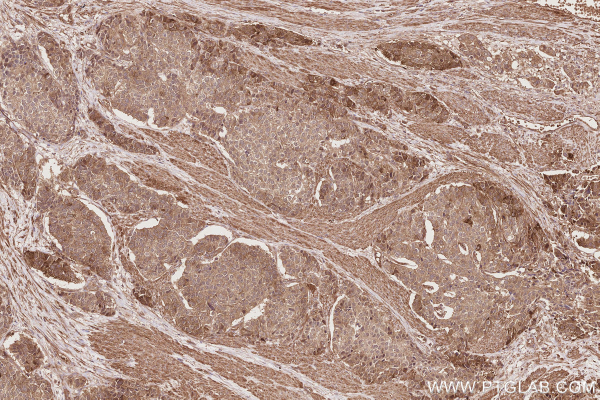 Immunohistochemical analysis of paraffin-embedded human stomach cancer tissue slide using KHC2858 (RIOK1 IHC Kit).