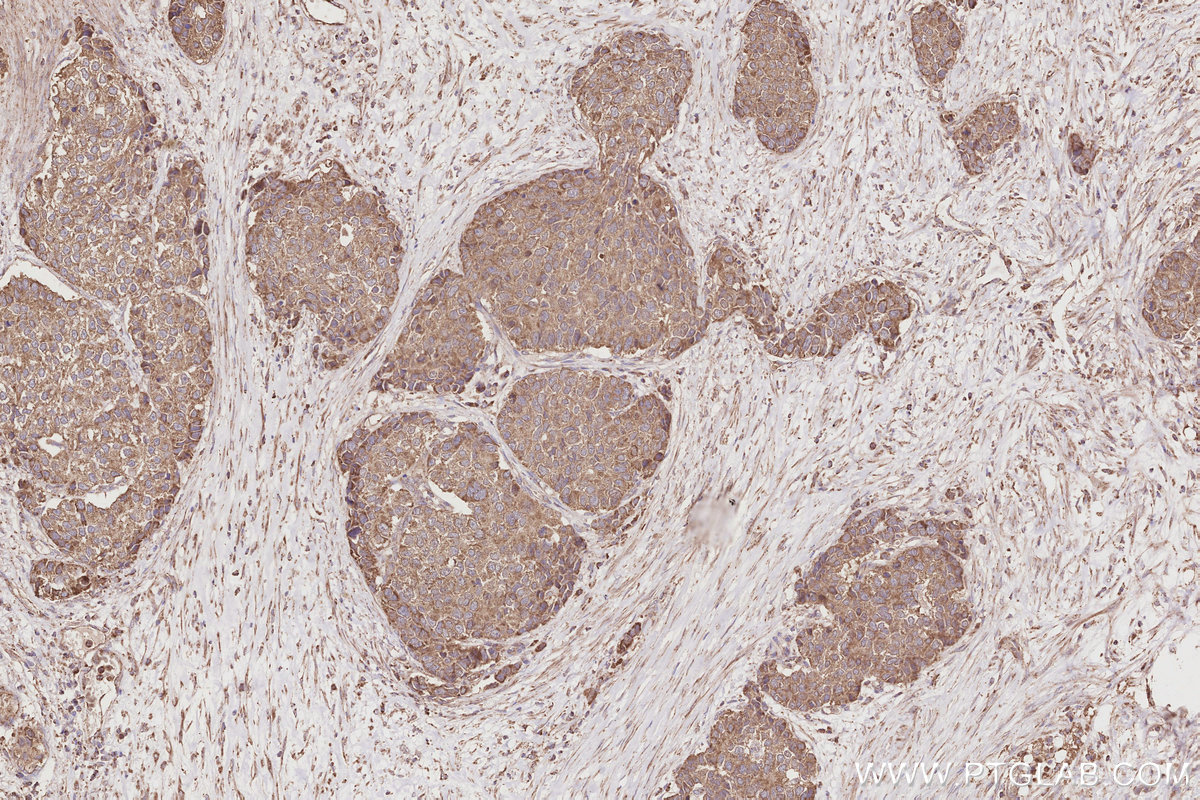 Immunohistochemical analysis of paraffin-embedded human stomach cancer tissue slide using KHC2874 (RIOK2 IHC Kit).