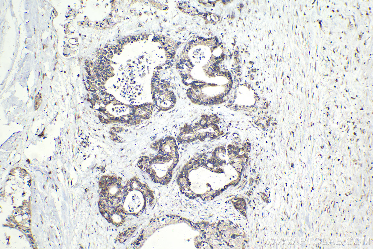 Immunohistochemical analysis of paraffin-embedded human pancreas cancer tissue slide using KHC2086 (RIPK2 IHC Kit).