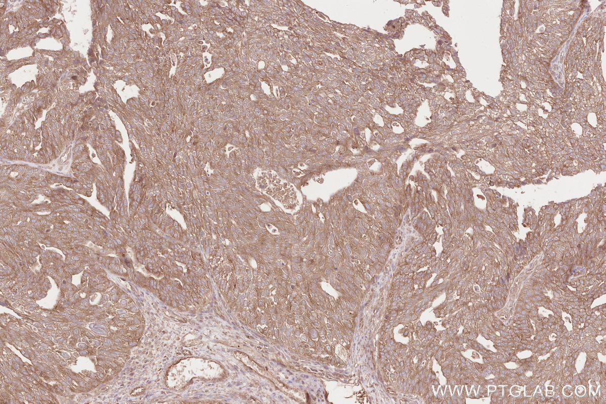Immunohistochemical analysis of paraffin-embedded human ovary cancer tissue slide using KHC2566 (RNF123 IHC Kit).