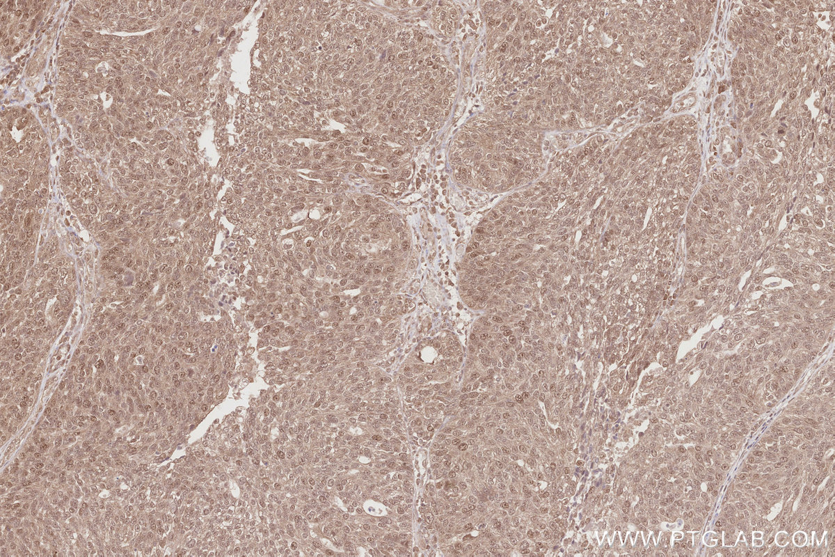 Immunohistochemical analysis of paraffin-embedded human ovary cancer tissue slide using KHC2871 (RNF126 IHC Kit).