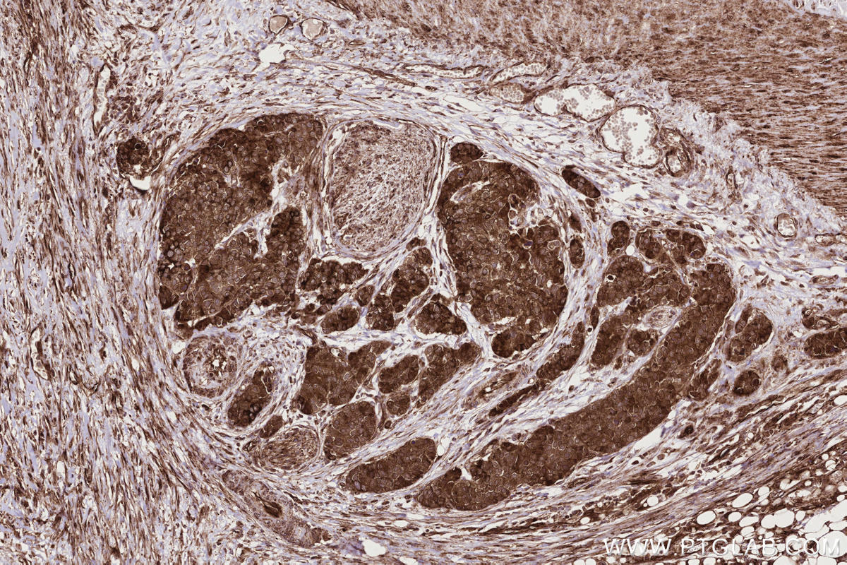 Immunohistochemical analysis of paraffin-embedded human stomach cancer tissue slide using KHC2730 (RNF139 IHC Kit).