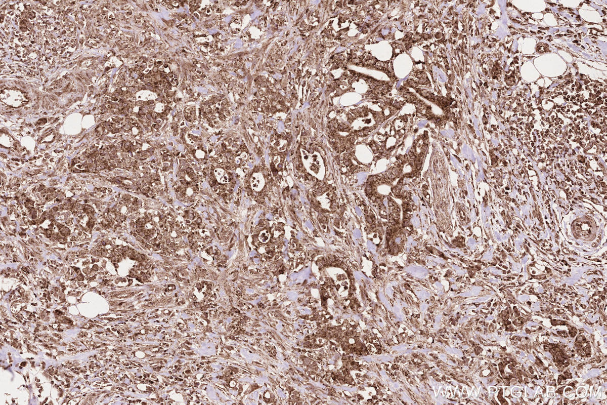 Immunohistochemical analysis of paraffin-embedded human rectal cancer tissue slide using KHC2565 (RNF219 IHC Kit).