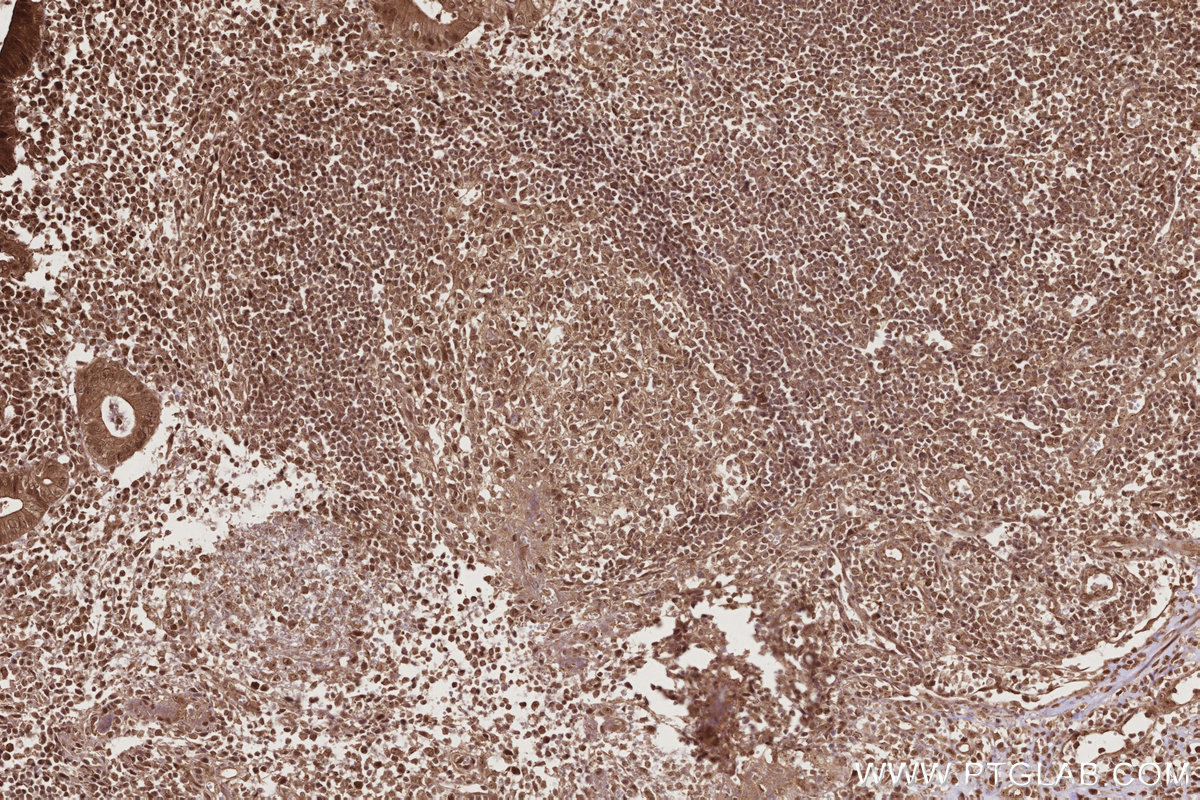 Immunohistochemical analysis of paraffin-embedded human appendicitis tissue slide using KHC2773 (RNF34 IHC Kit).